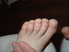 Onychomycosis