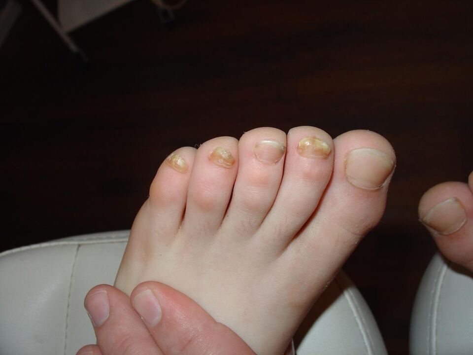 Gaixotasunaren agerpena