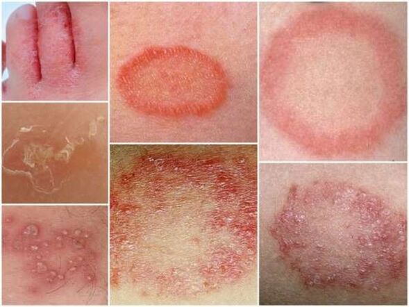 Hanken azaleko trikofitosia