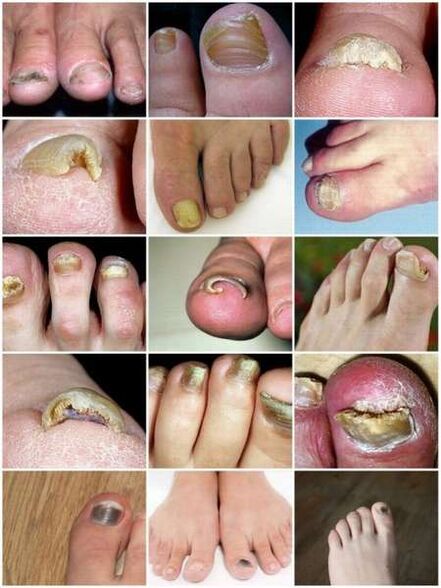 Oinetako iltze-plakaren onddoen infekzioa