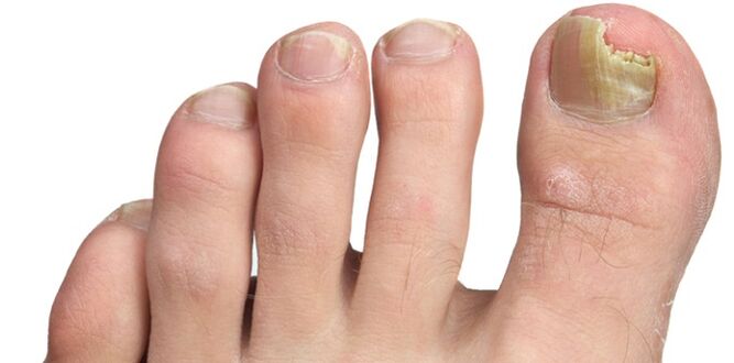 iltze-plakaren onddoen infekzioa